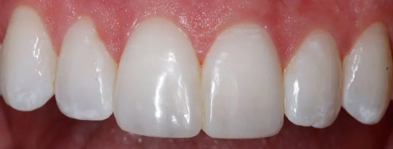 after veneers