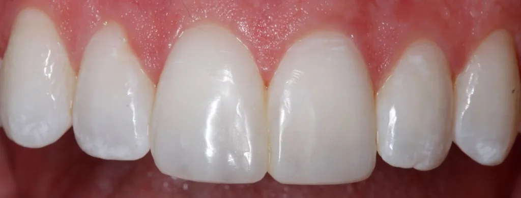 after veneers