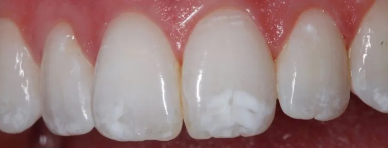 before veneers