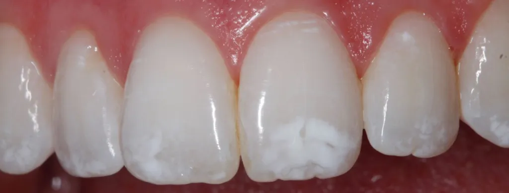 before veneers
