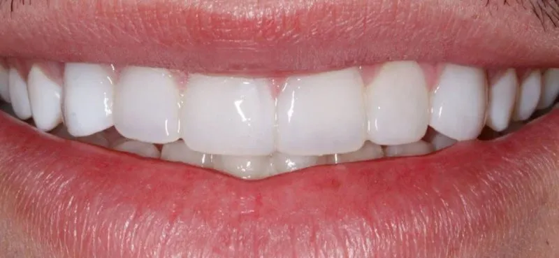 after veneers