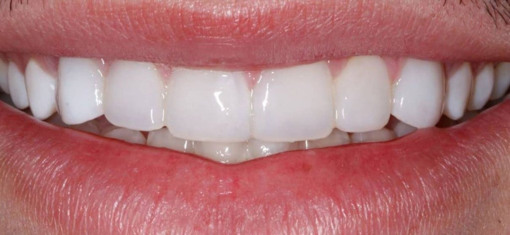 after veneers