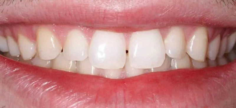 before veneers