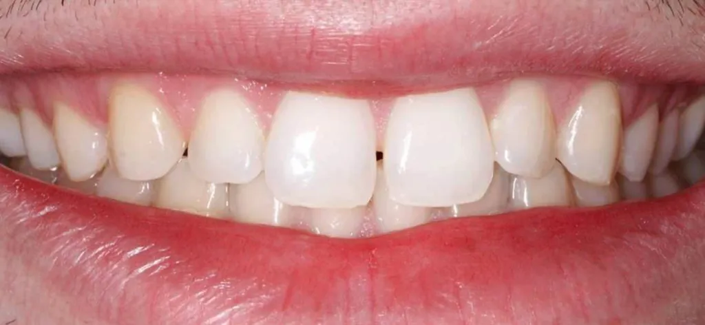 before veneers