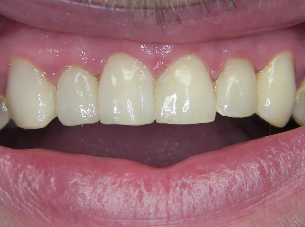 after veneers