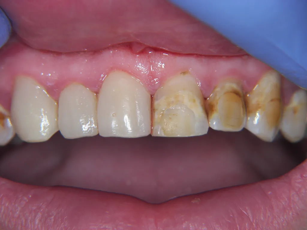 before veneers