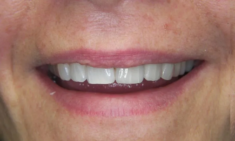 after veneers and crowns
