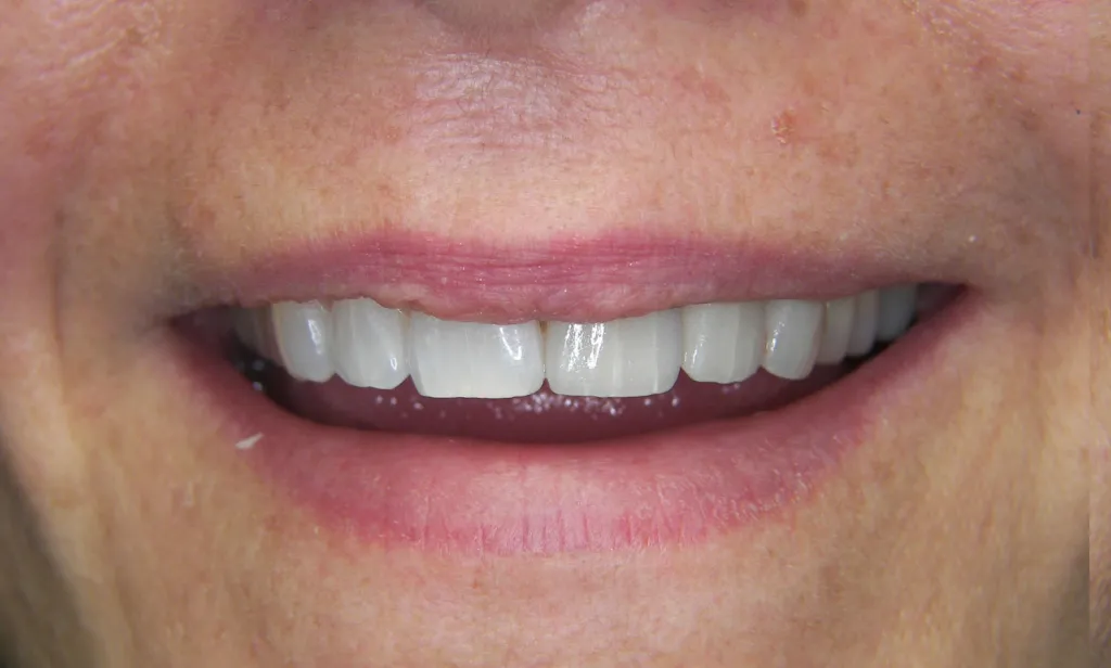 after veneers and crowns