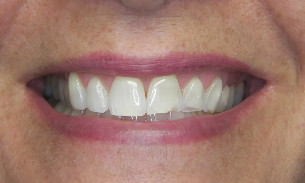 before veneers and crowns