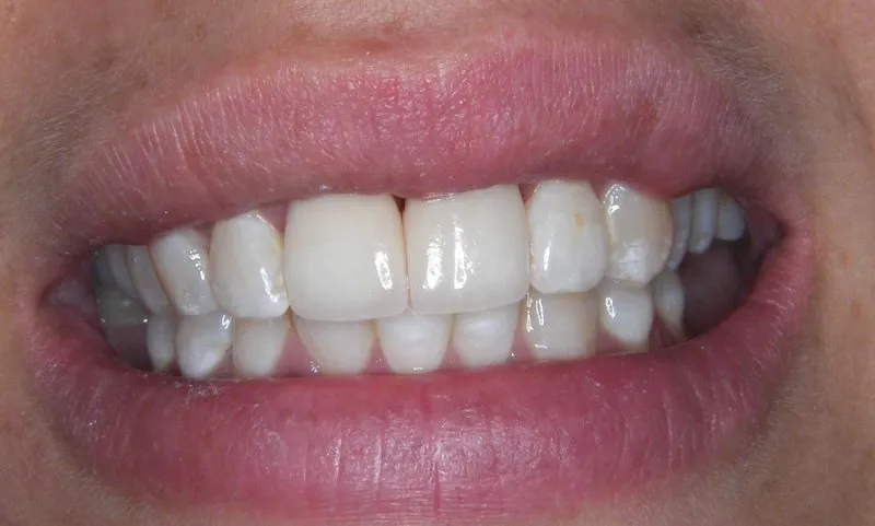 after invisalign