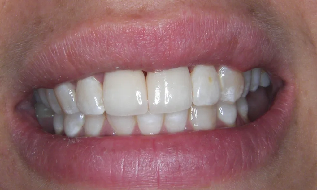 after invisalign