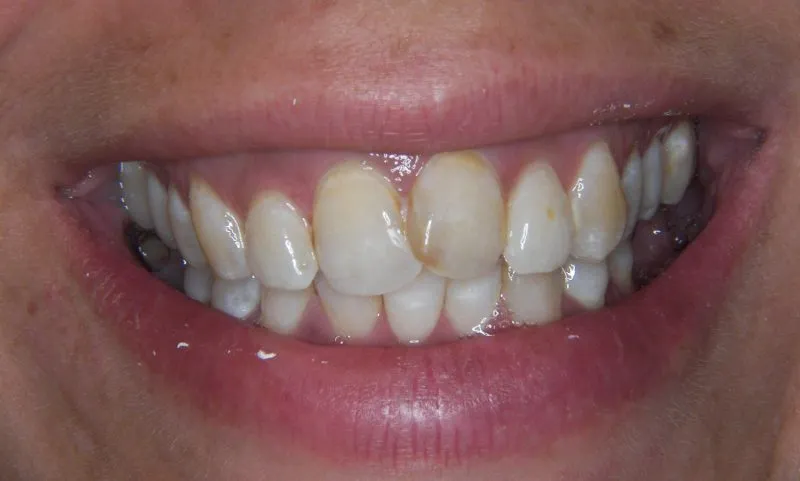 before invisalign