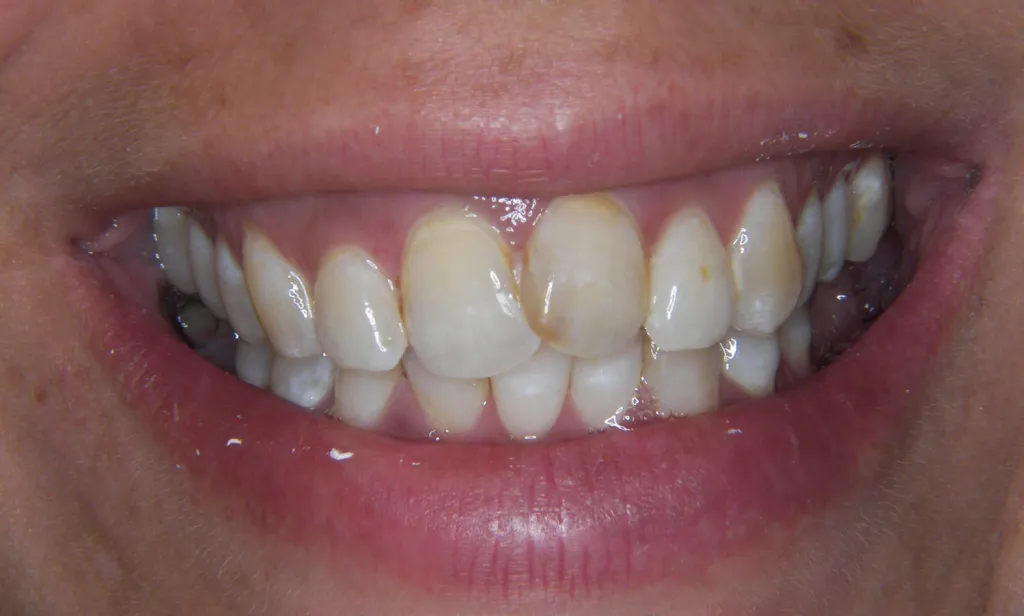 before invisalign