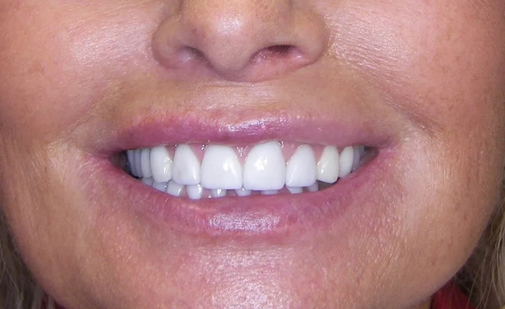 after Complete smile make-over