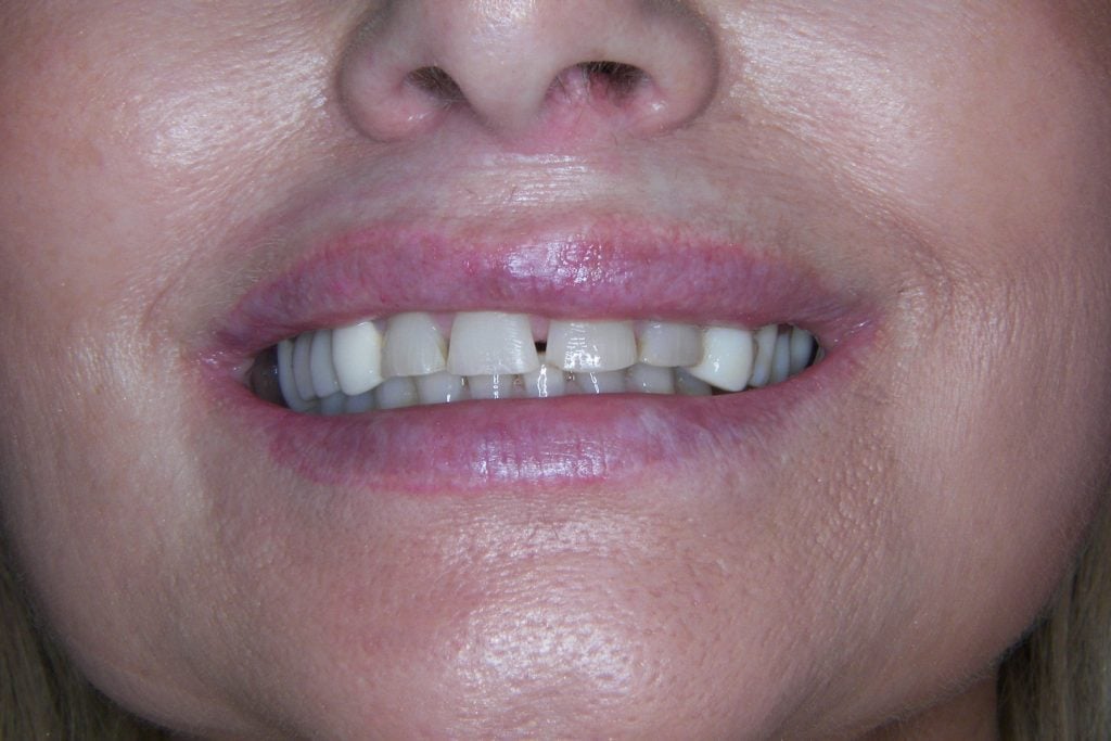 before Complete smile make-over