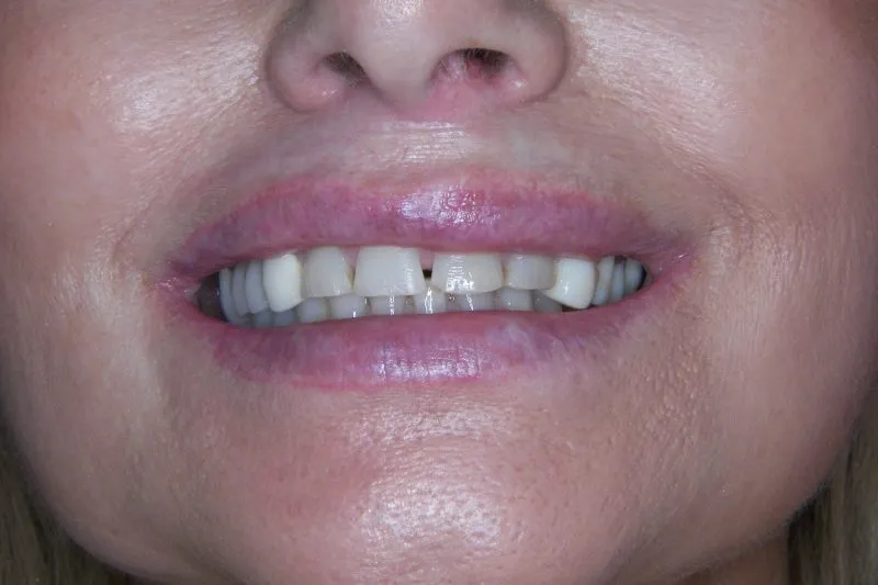before Complete smile make-over